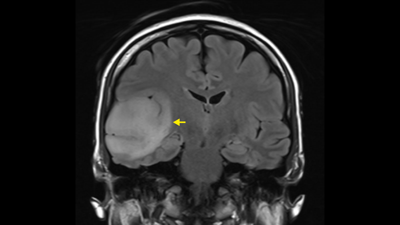 MRI with FLAIR sequence shows a low-grade glioma as a bright area. The tumor is marked with a yellow arrow.