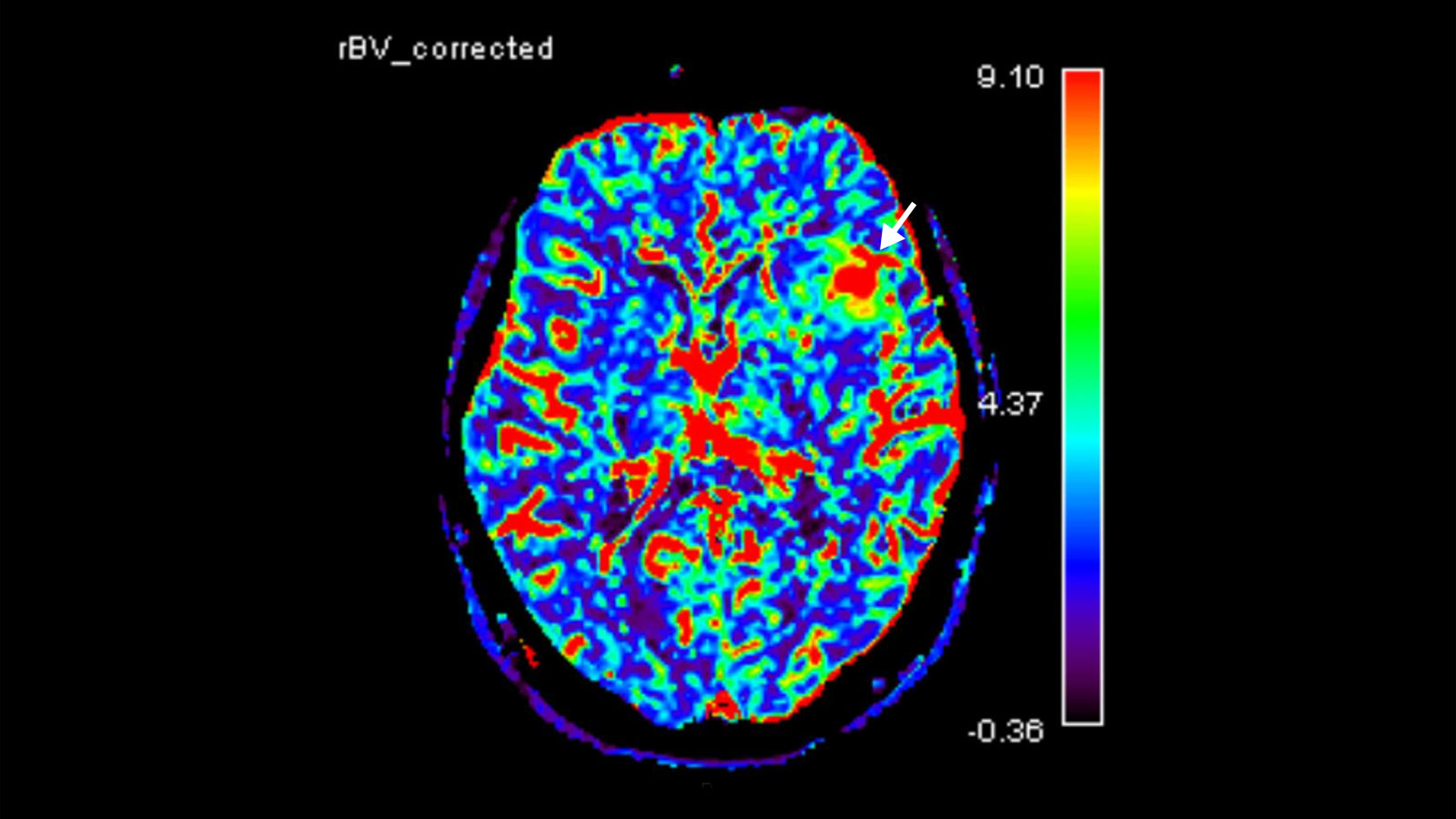 MRI mit Perfusionssquenz zeigt den Blutfluss des Gehirns in Farben. Ein Pfeil zeigt auf den Tumor. Dort ist farbig ein erhöhtes Blutvolumen zu erkennen.
