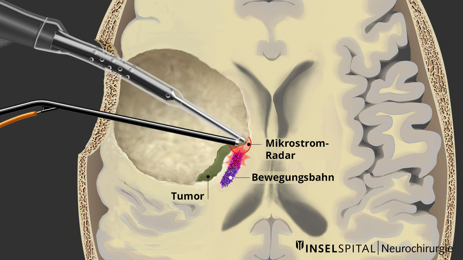 Hirnquerschnitt mit Tumor, Bewegungsbahn und Mapping-Sonde. Die ​​Sonde gibt ein Signal und meldet dem Chirurg die naheliegende Bewegungsbahn.​