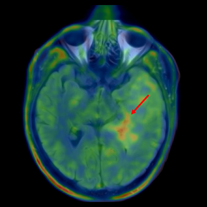 Farbige Bildüberlagerung von FET-PET- und MRI-Daten zeigt gelb-rötlichen Hotspot im Tumor, der besonders stark leuchtet. Der Bereich ist mit einem roten Pfeil markiert.