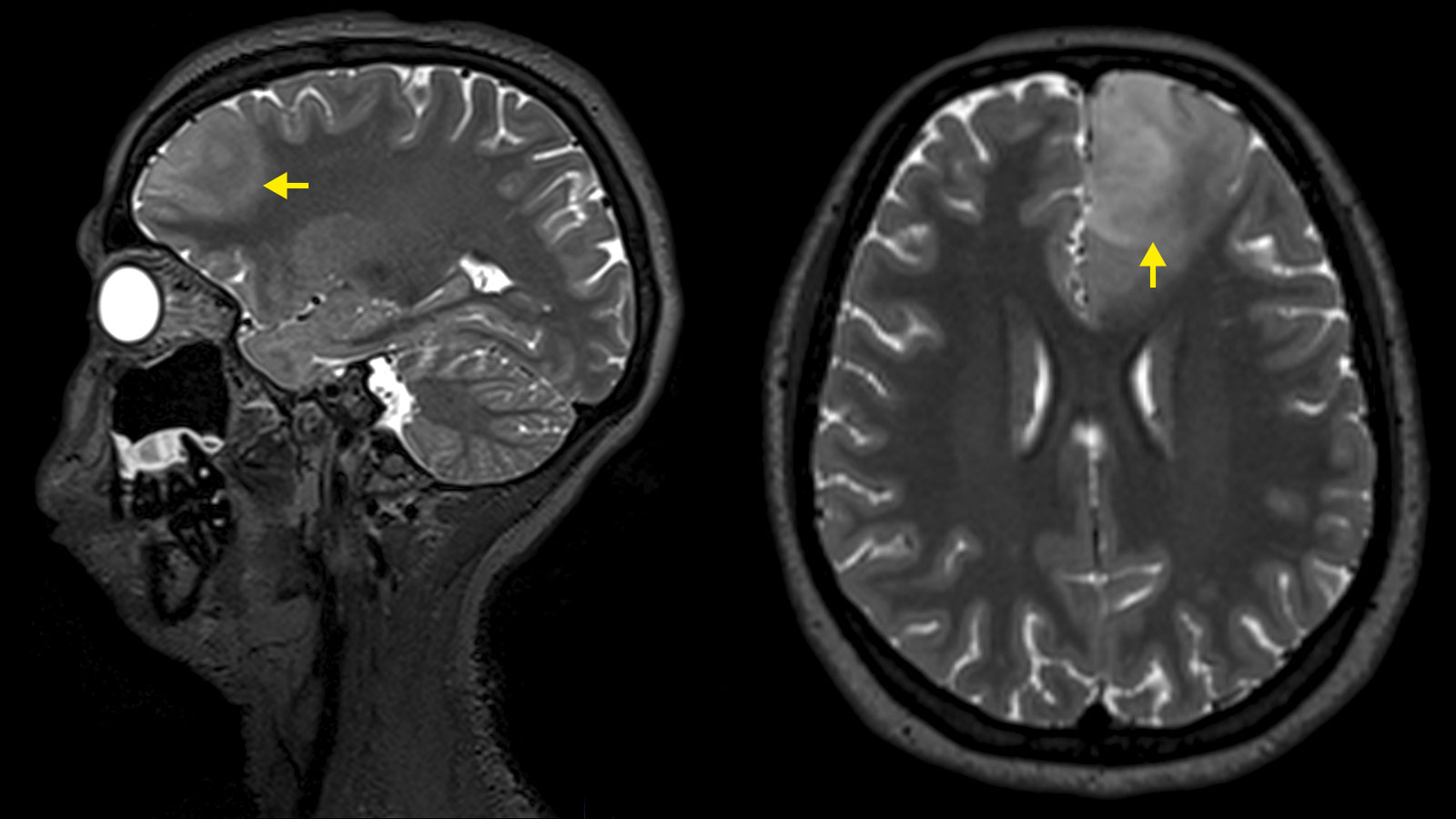 MRI-Aufnahme eines Astrozytoms. Links seitliche Aufnahme, rechts von oben. Der Tumor ist mit gelben Pfeilen markiert.