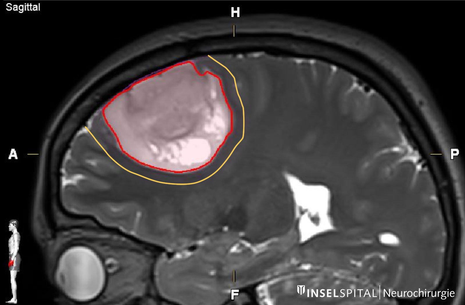 Sur l'image IRM, la tumeur (rouge) et la marge de sécurité autour de la tumeur (jaune) sont marquées. 
