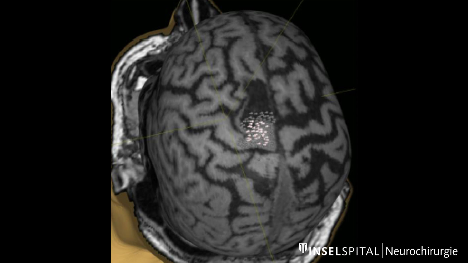 Image of a navigated transcranial magnetic stimulation with white and gray dots in the area of the measurement