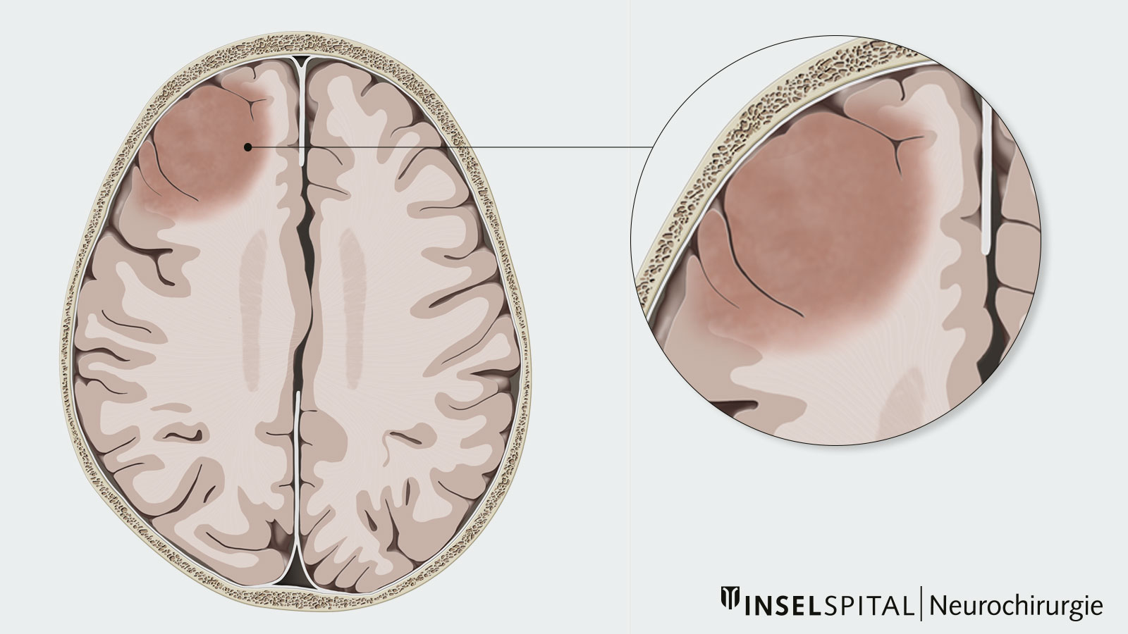 Color drawing of a low-grade astrocytoma. Left: overview drawing of infiltration. Right detail drawing: tissue displacement.