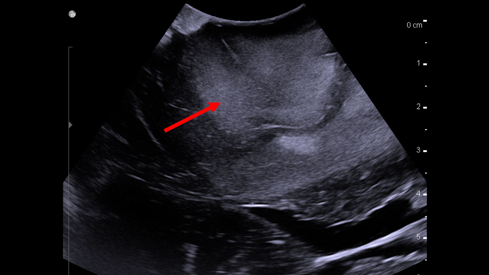 Ultraschallbild zeigt Tumor als helleres Areal in der oberen Bildmitte. Ein roter Pfeil zeigt auf den Tumor.