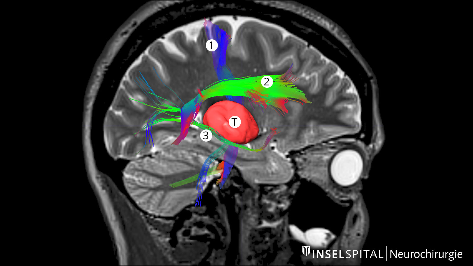 Fiber-Tracking-Aufnahme mit rot, grün und blau markierten Hirnfaserbahnen