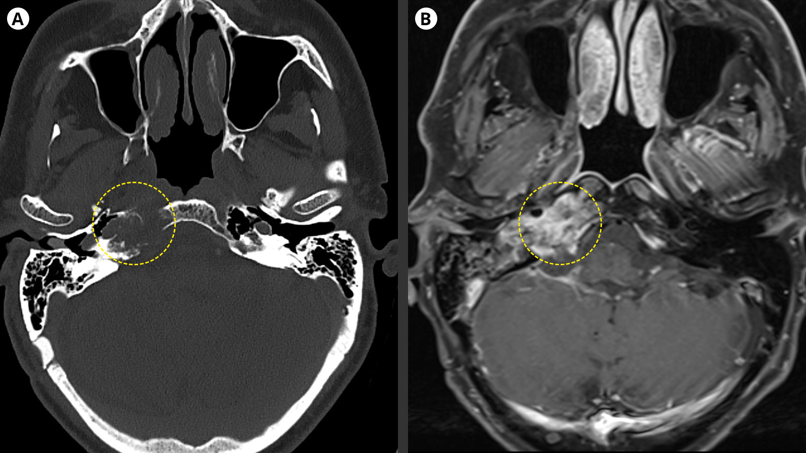 Image CT gauche d'un crâne atteint de chondrosarcome montrant de petites calcifications détruisant l'os. Image IRM droite d'un crâne avec prise de produit de contraste de la tumeur.