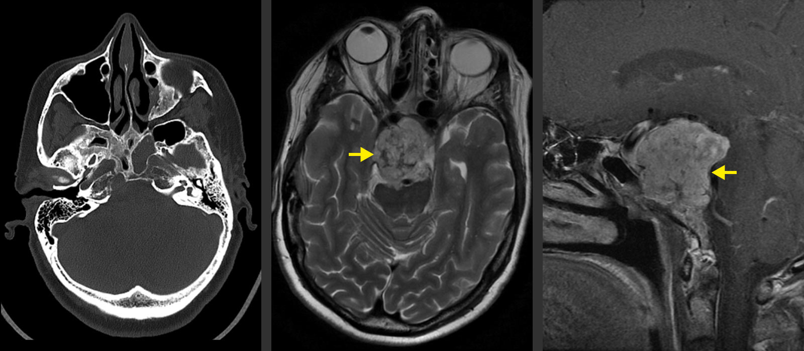 Dreiteilige Abbildung. Links ein Schädel-CT mit Chordom und sichtbarer Knochenzerstörung, in der Mitte und rechts Schädel-MRIs. Kleine gelbe Pfeile deuten jeweils auf die Chordome.