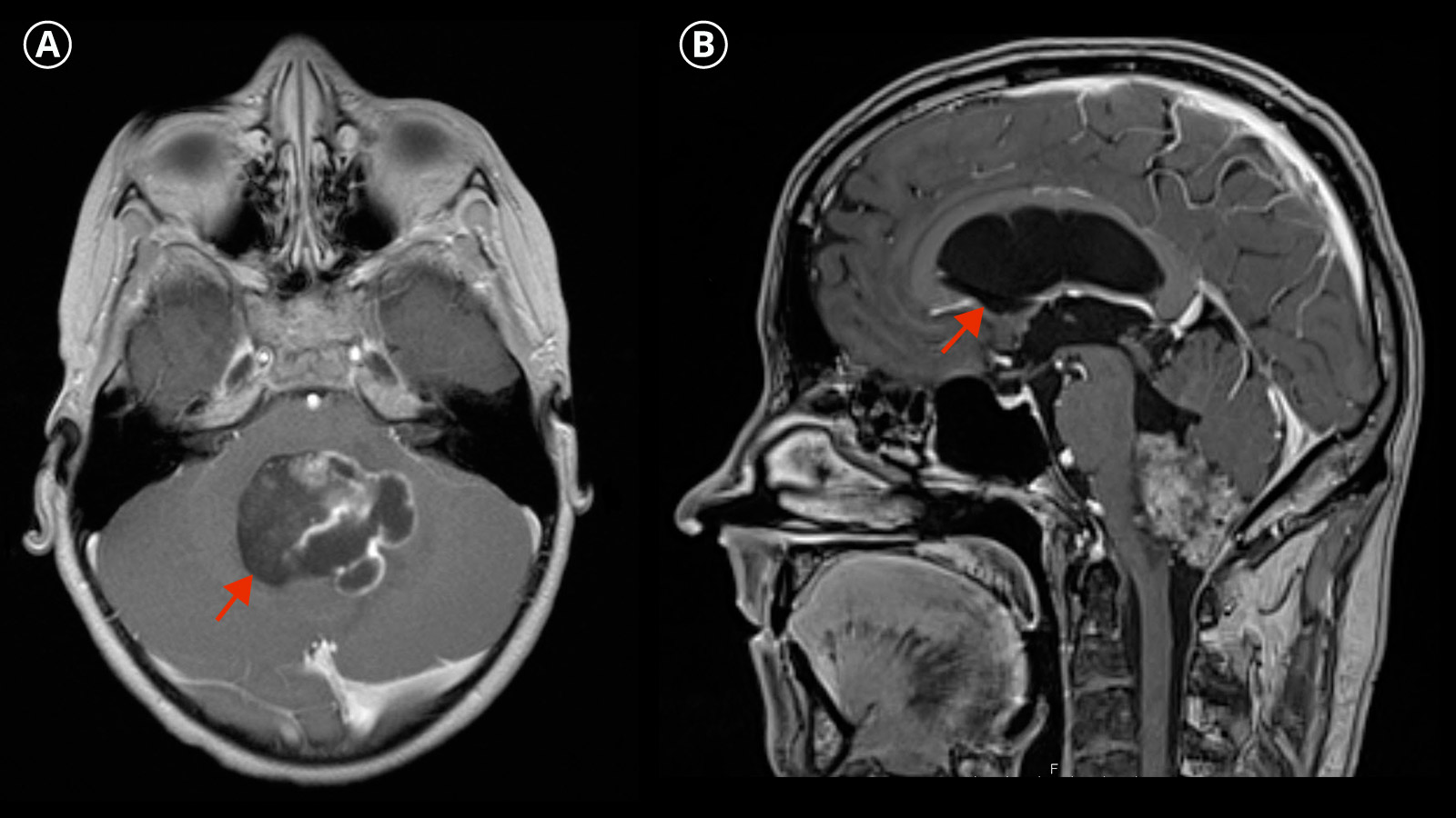 2 different MRI images (T1, T2) of an ependymoma
