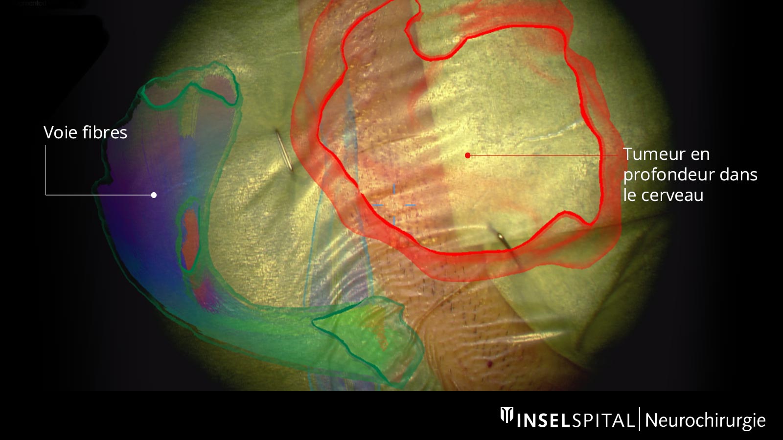 Image du crâne avec structures colorées de la tumeur et des voies de fibres superposées par RA 