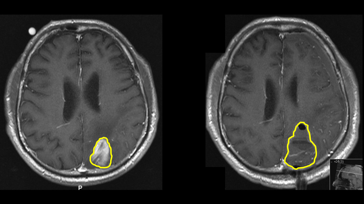 2 MRI images in comparison: tumor before surgery and the tumor actually removed with 5-ALA