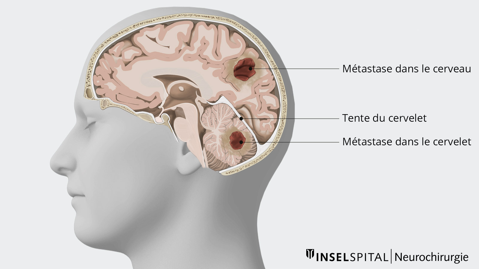 Dessin du crâne pour la localisation des métastases cérébrales