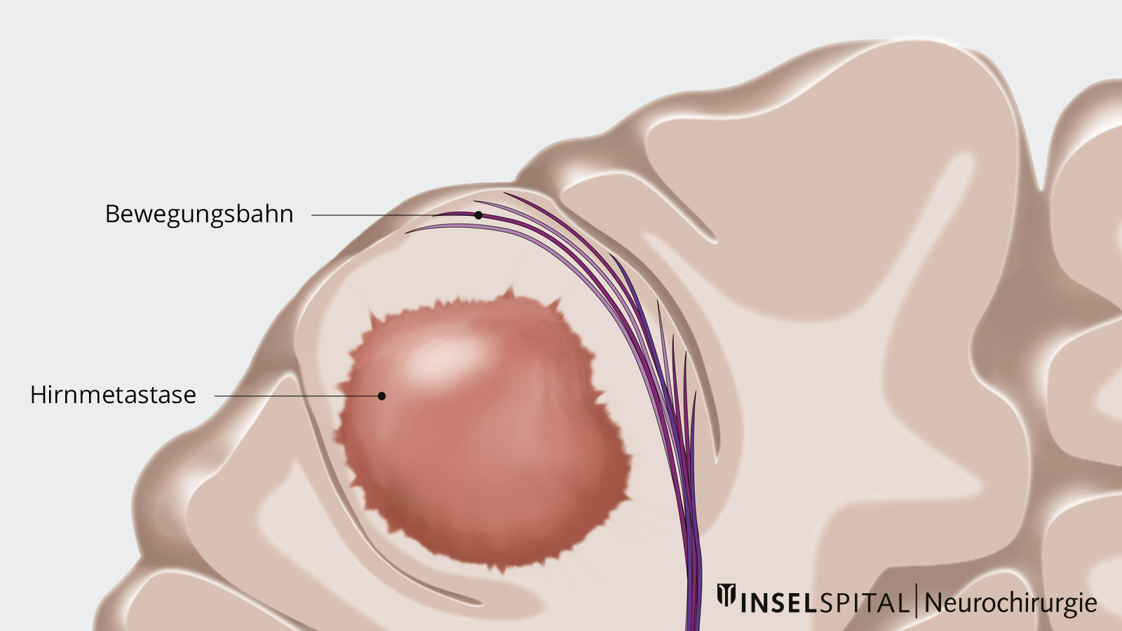 ​Zeichnung einer Hirnmetastase mit Infiltration in das umliegende Gewebe