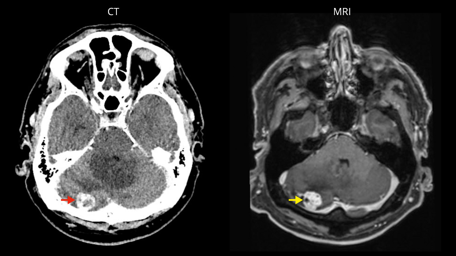 Left CT image of cerebellar metastasis, right same metastasis in MRI image.