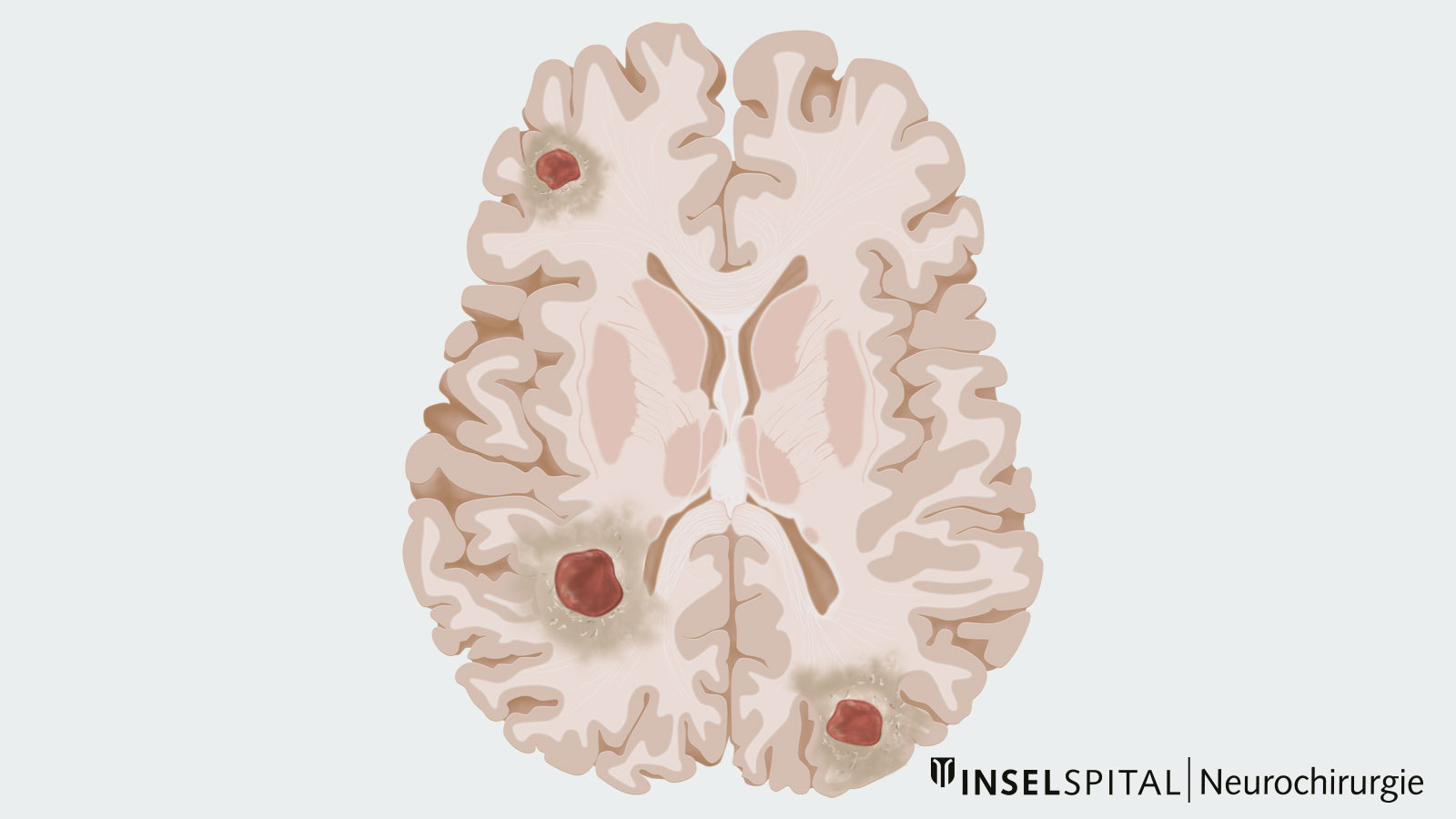 Zeichnung von mehreren Hirnmetastasen
