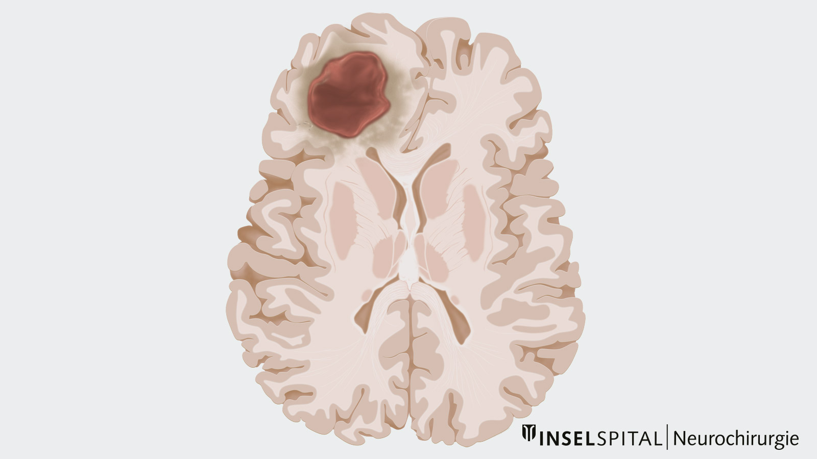 Zeichnung einer einzelnen Metastase im Hirn