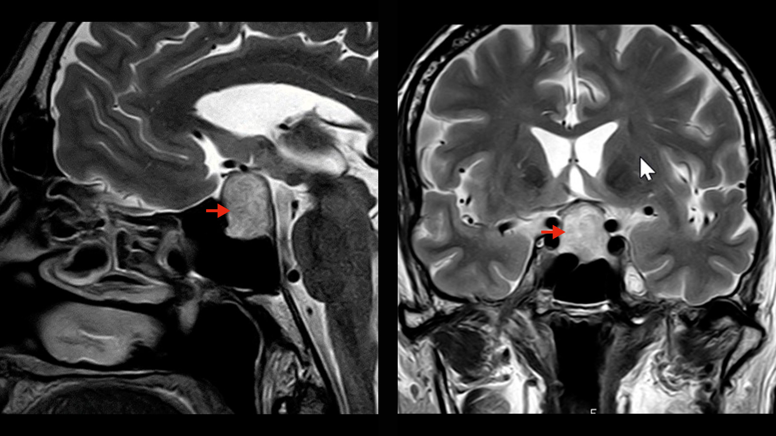 2 MRI images of a macroadenoma on the pituitary gland