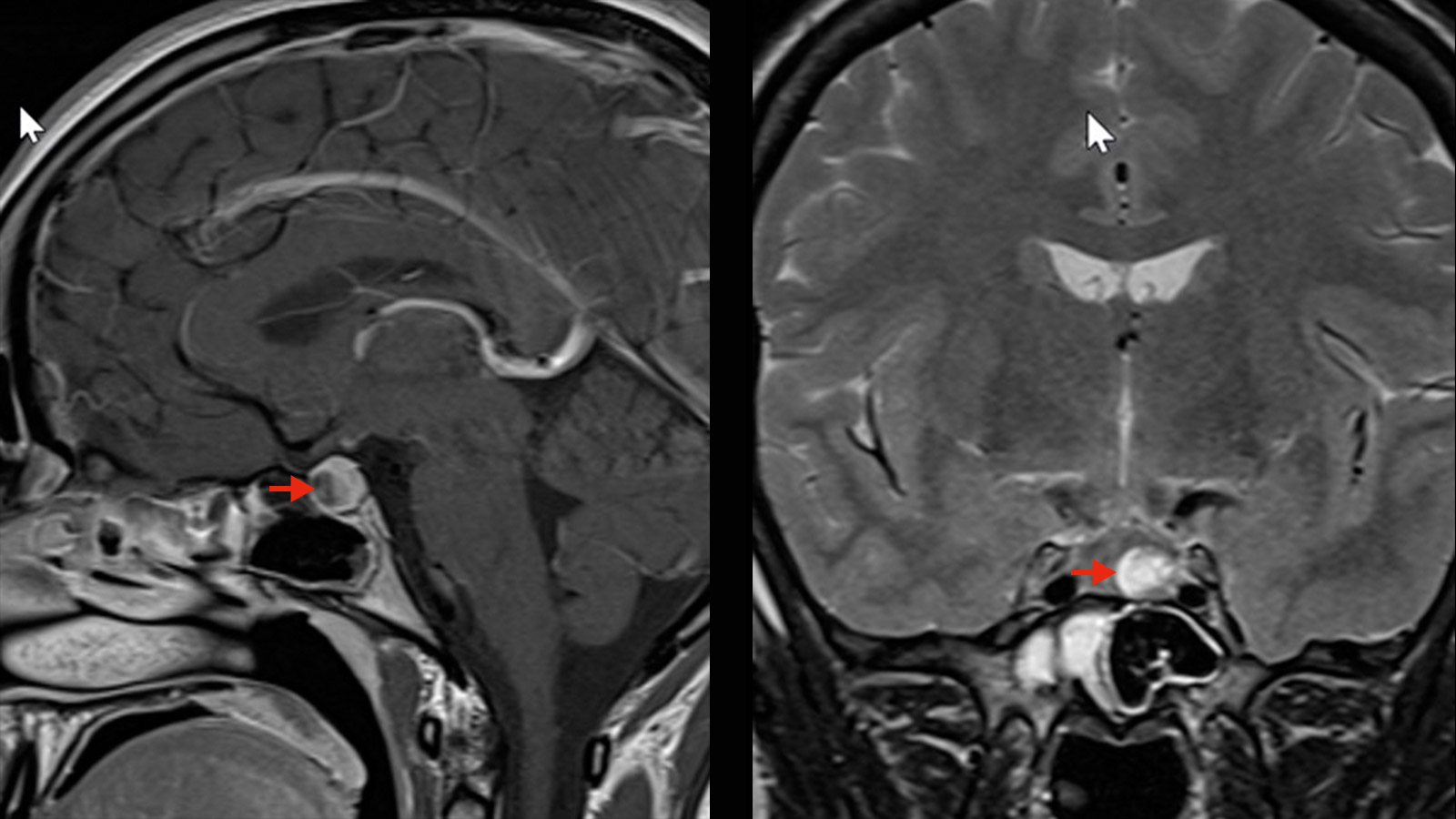 2 MRI-Aufnahmen eines Mikroadenoms an der Hypophyse