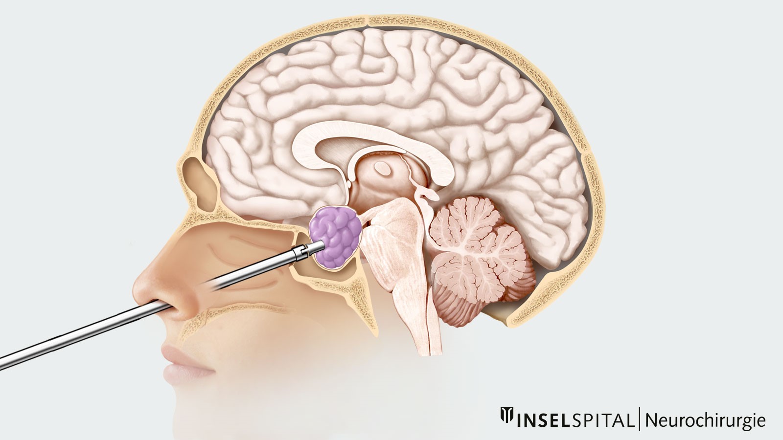Color drawing for transnasal transsphenoidal approach via the nose to the pituitary adenoma