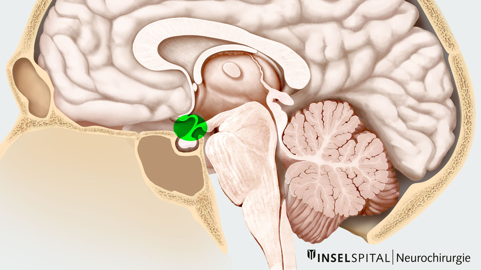 Skull drawing. The area where craniopharyngeomas normally grow is marked in green.
