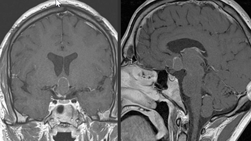 MRI image of craniopharyngeoma