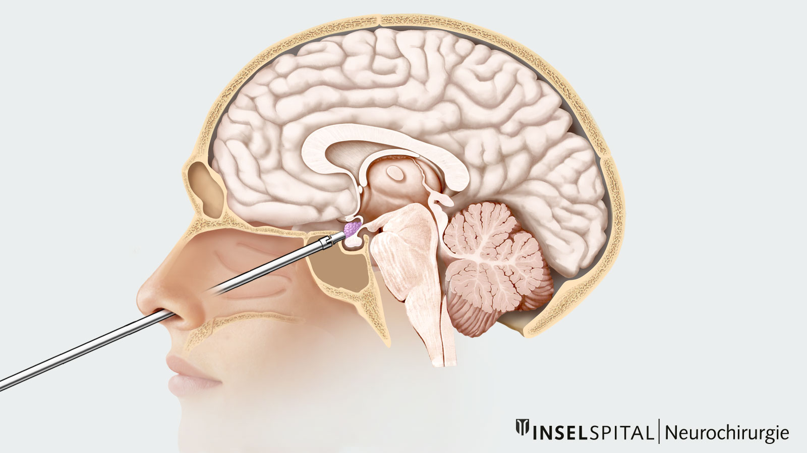 Color drawing for transnasal transsphenoidal approach via the nose to the tumor