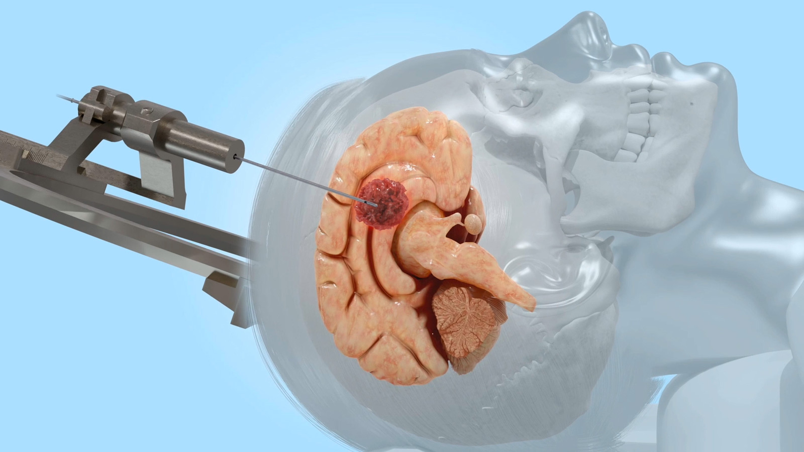 Représentation schématique d'une biopsie stéréotaxique