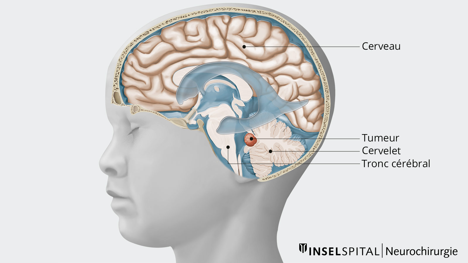 Dessin du crâne en coupe transversale avec le cerveau, le cervelet, le tronc cérébral et la tumeur