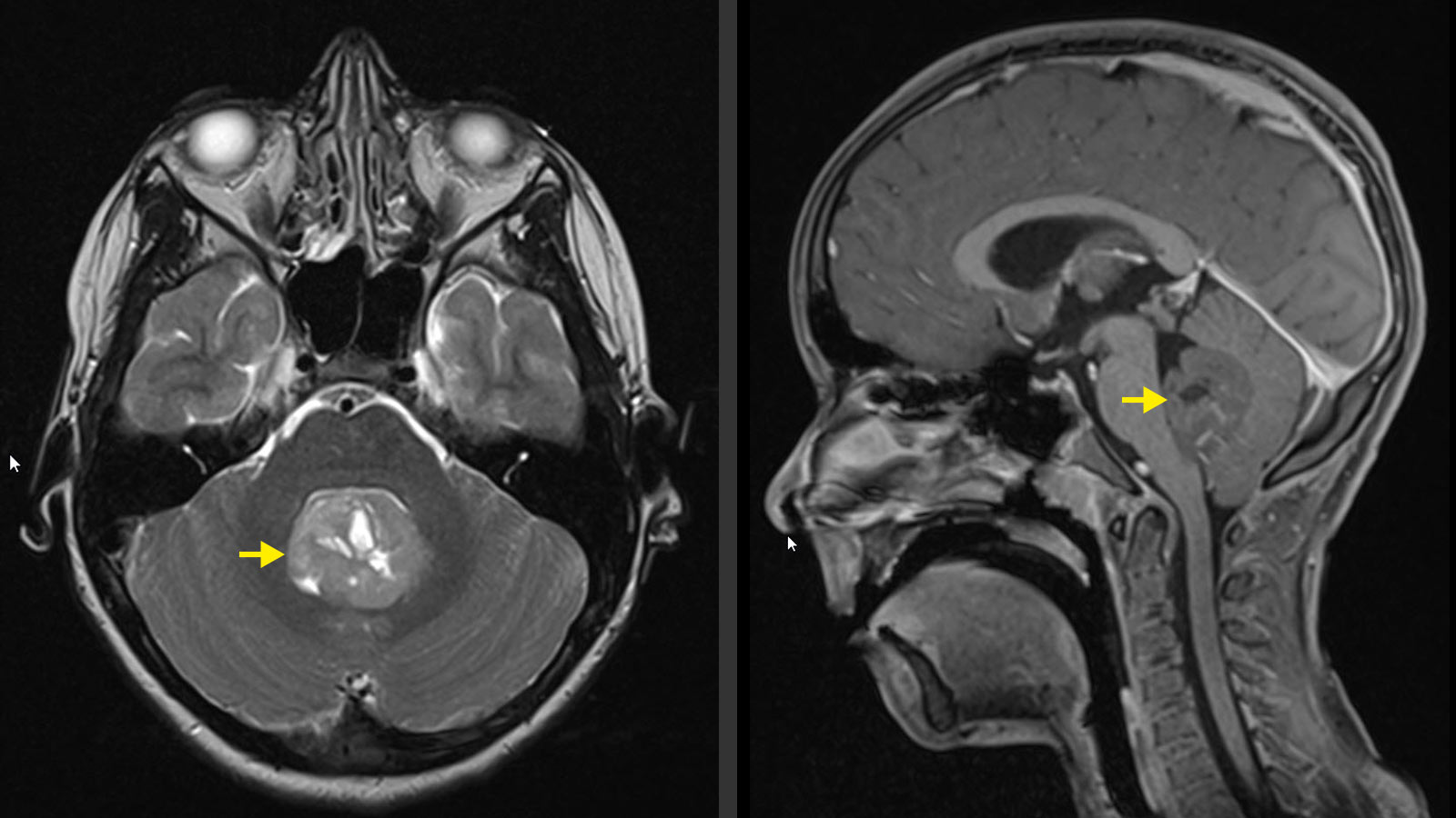​MRI-Bild eines Medulloblastoms. Tumor ist mit gelben Pfeilen markiert.​