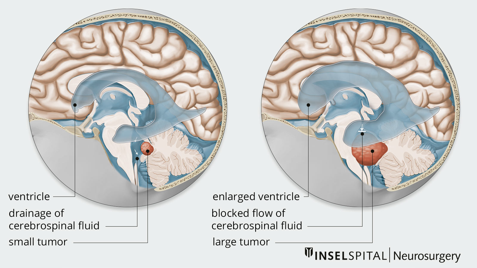 Two drawings placed side by side: Left, small tumor with normal cerebrospinal fluid outflow; right, larger tumor with impaired cerebrospinal fluid outflow.