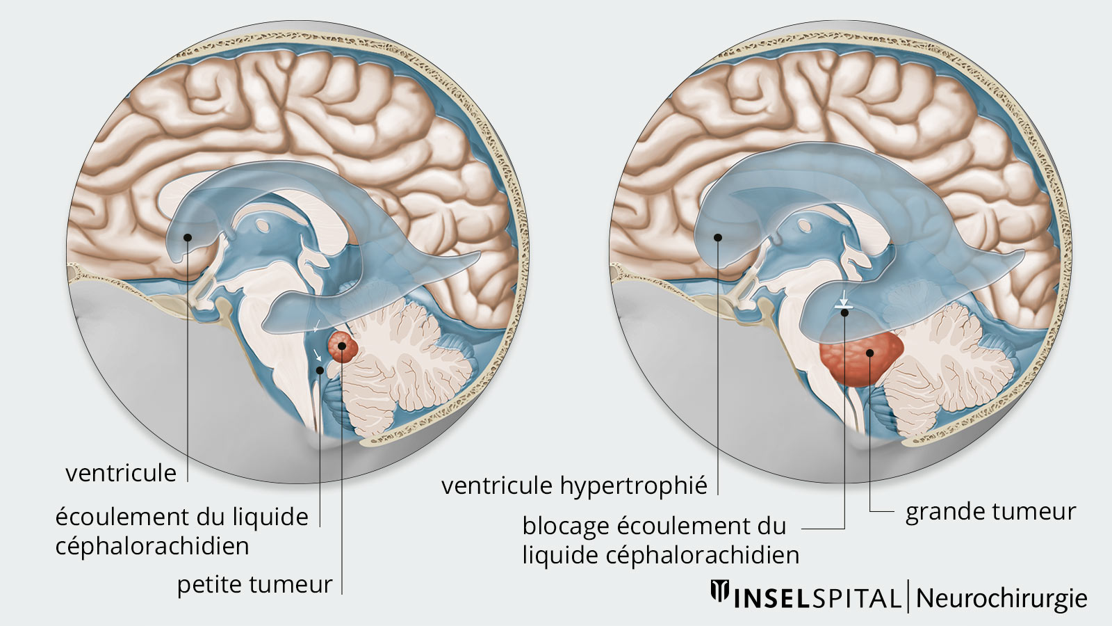 Deux dessins mis côte à côte : A gauche, petite tumeur avec un écoulement normal du liquide céphalorachidien ; à droite, tumeur plus importante avec un écoulement perturbé du liquide céphalorachidien.