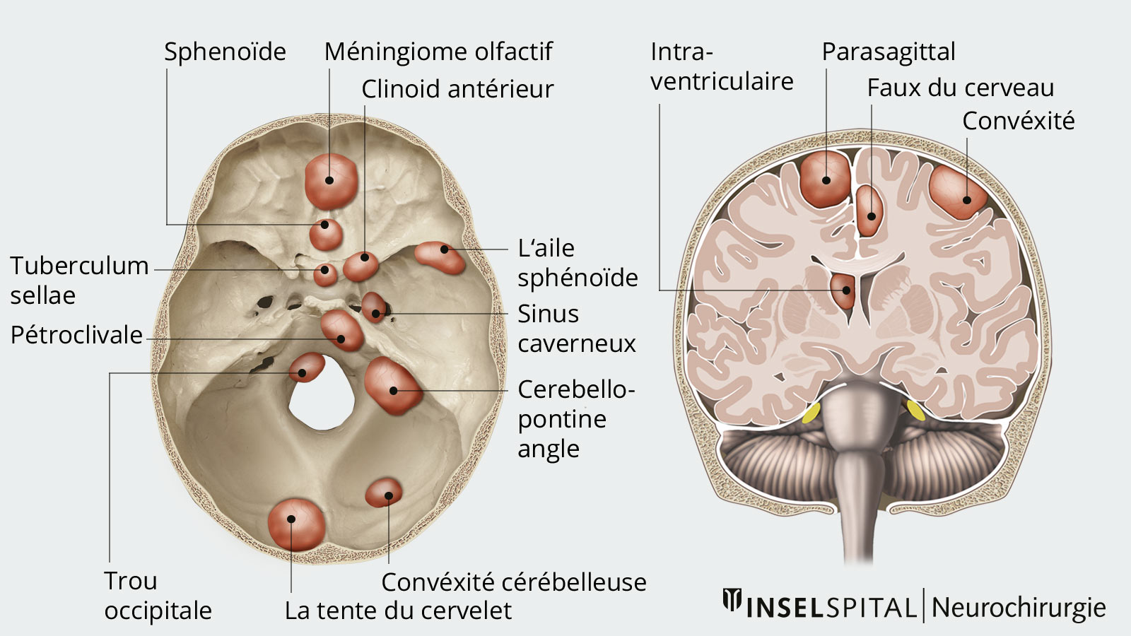 Méningeome | Neurochirurgie Inselspital Bern