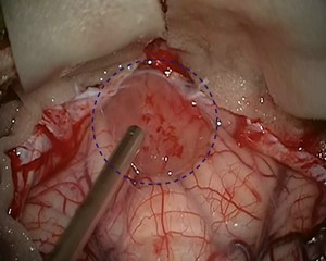 Operative photo. The tumor is marked in a circle.
