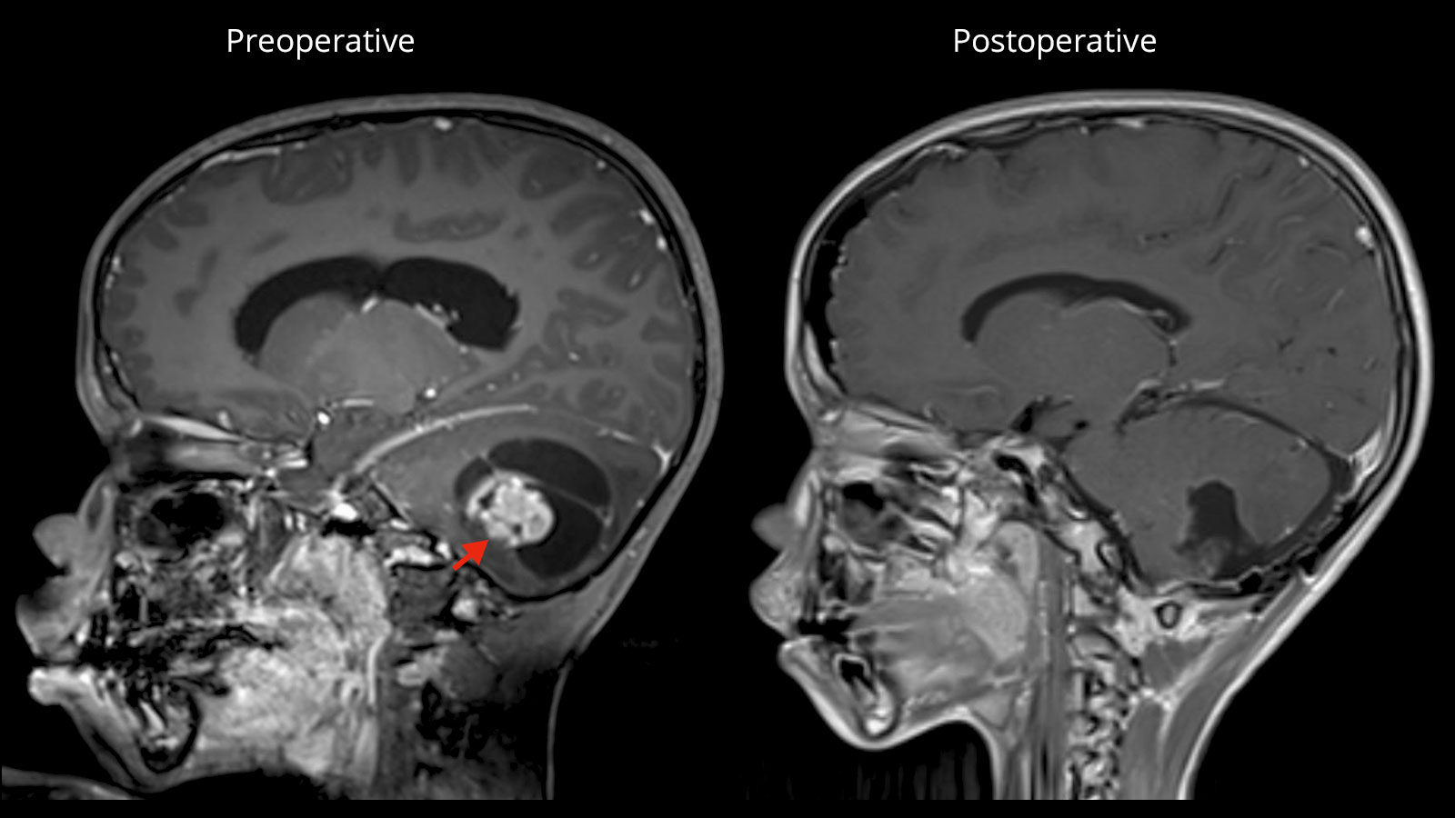 MRI image of the tumor before and after surgery