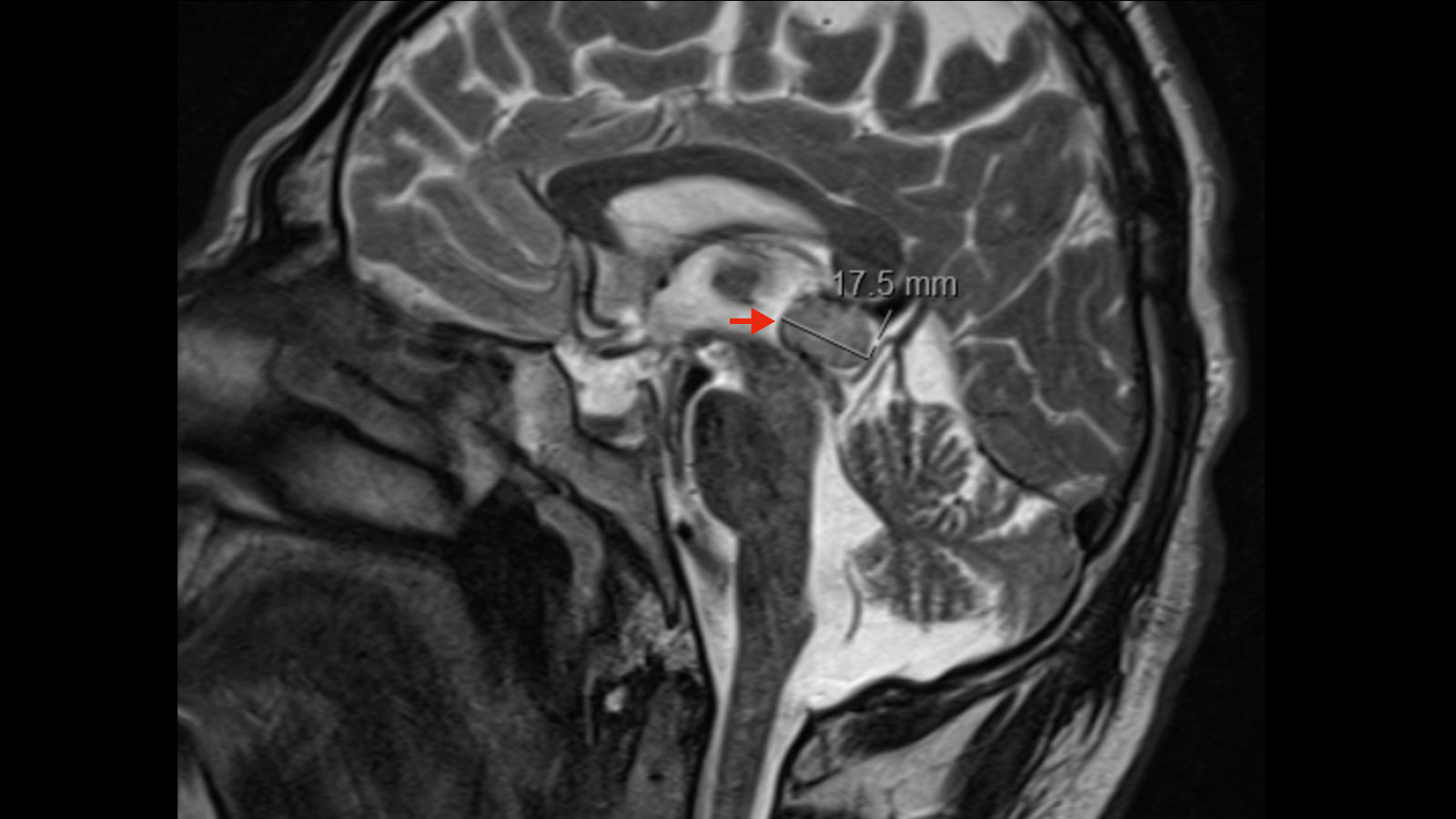 MRI image of a pineocytoma