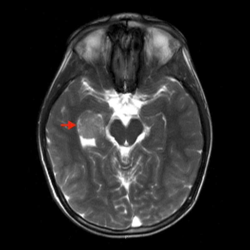 MRI image of a plexus papilloma in the right ventricle