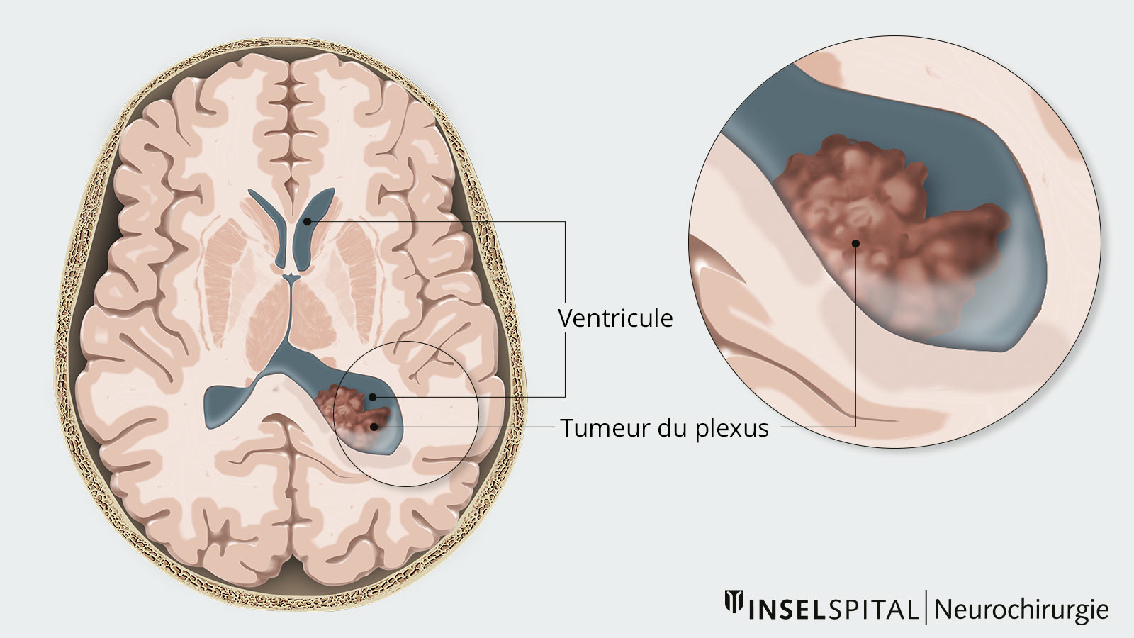 Tumeur du plexus | Neurochirurgie Inselspital Bern
