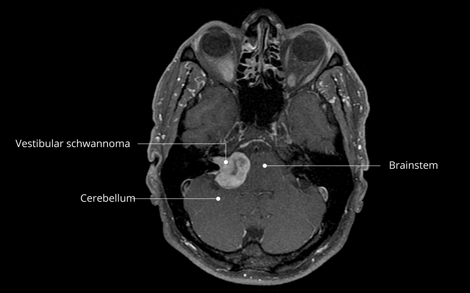 MRI of a vestibular schwannoma