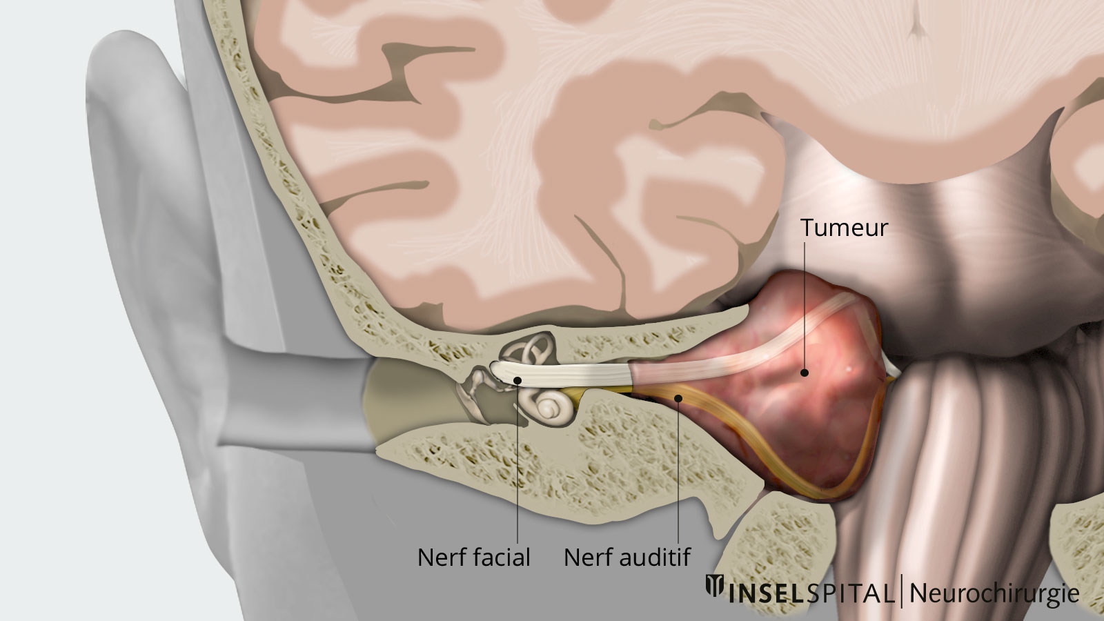 Vue d'ensemble de l'oreille interne avec les nerfs crâniens et la tumeur