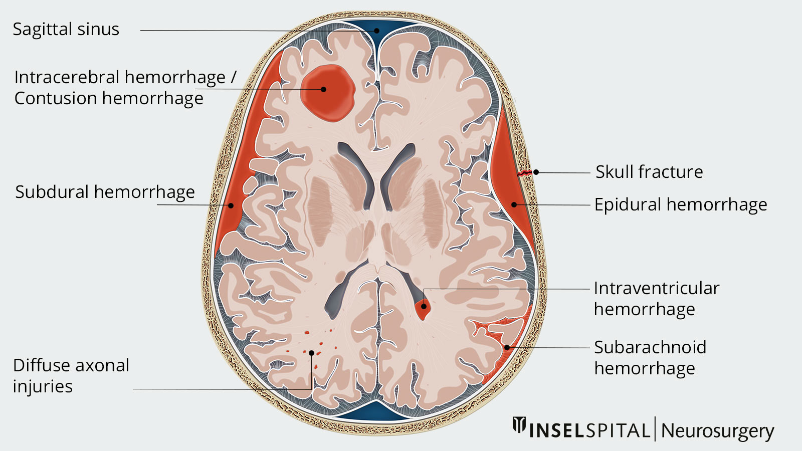 Illustration of various types of traumatic brain hemorrhages in children