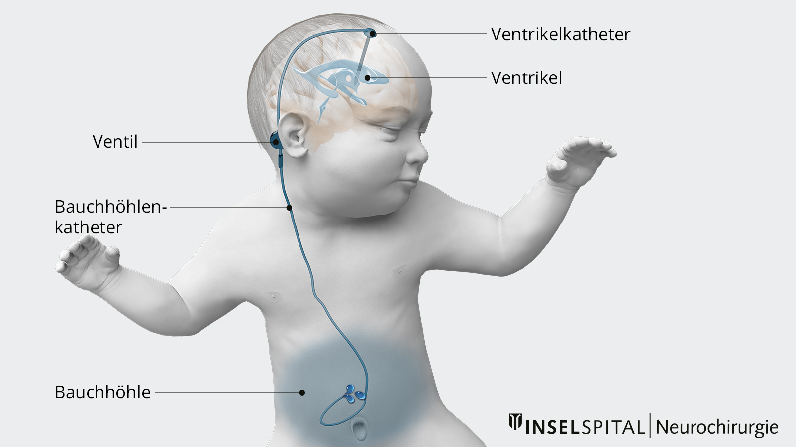 Zeichnung eines ventrikuloperitonealen Shunts bei einem Baby