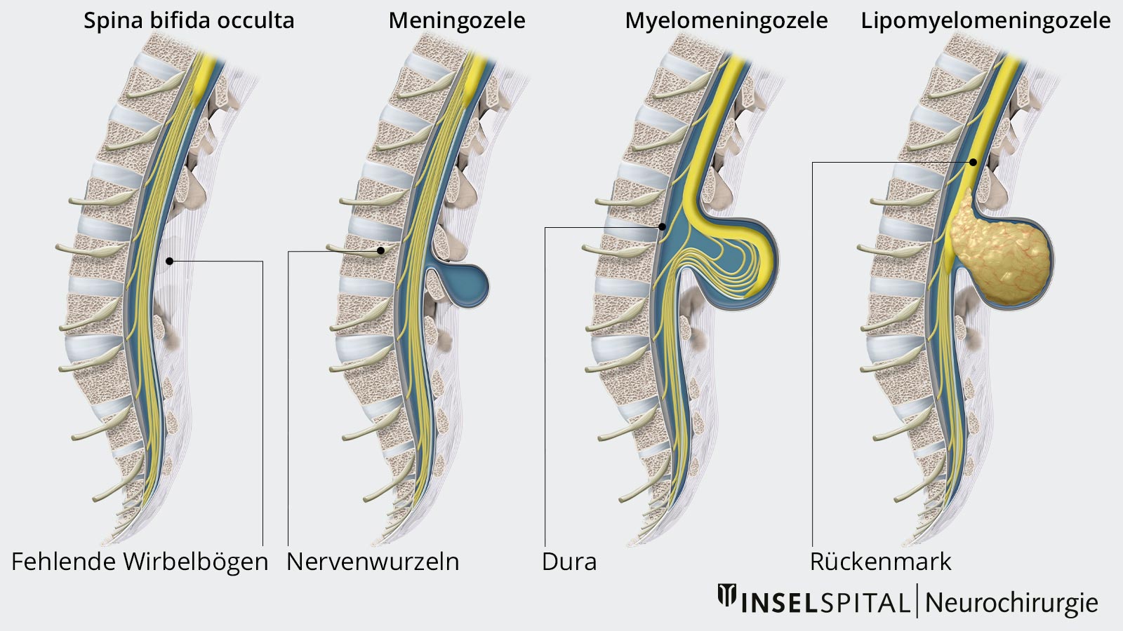 Die Grafik zeigt vier Ausprägungen von Spina bifida mit den jeweils betroffenen Strukturen der Wirbelsäule