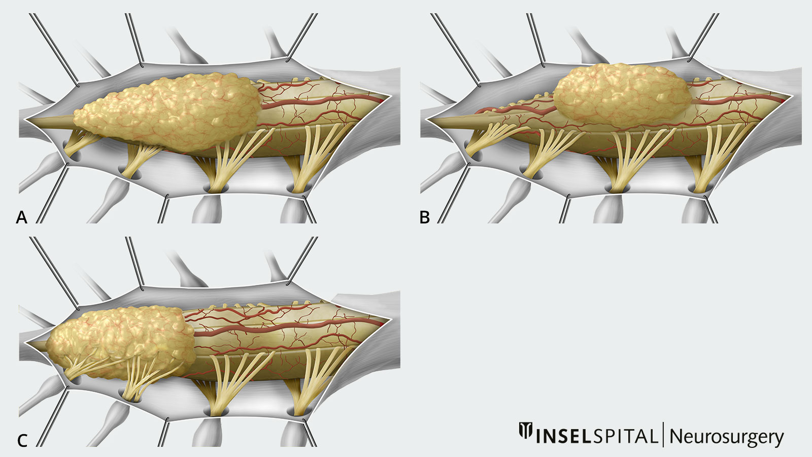 Übersichtszeichnung zur Einteilung von verschiedenen spinalen Lipomen nach ihrer Lokalisation