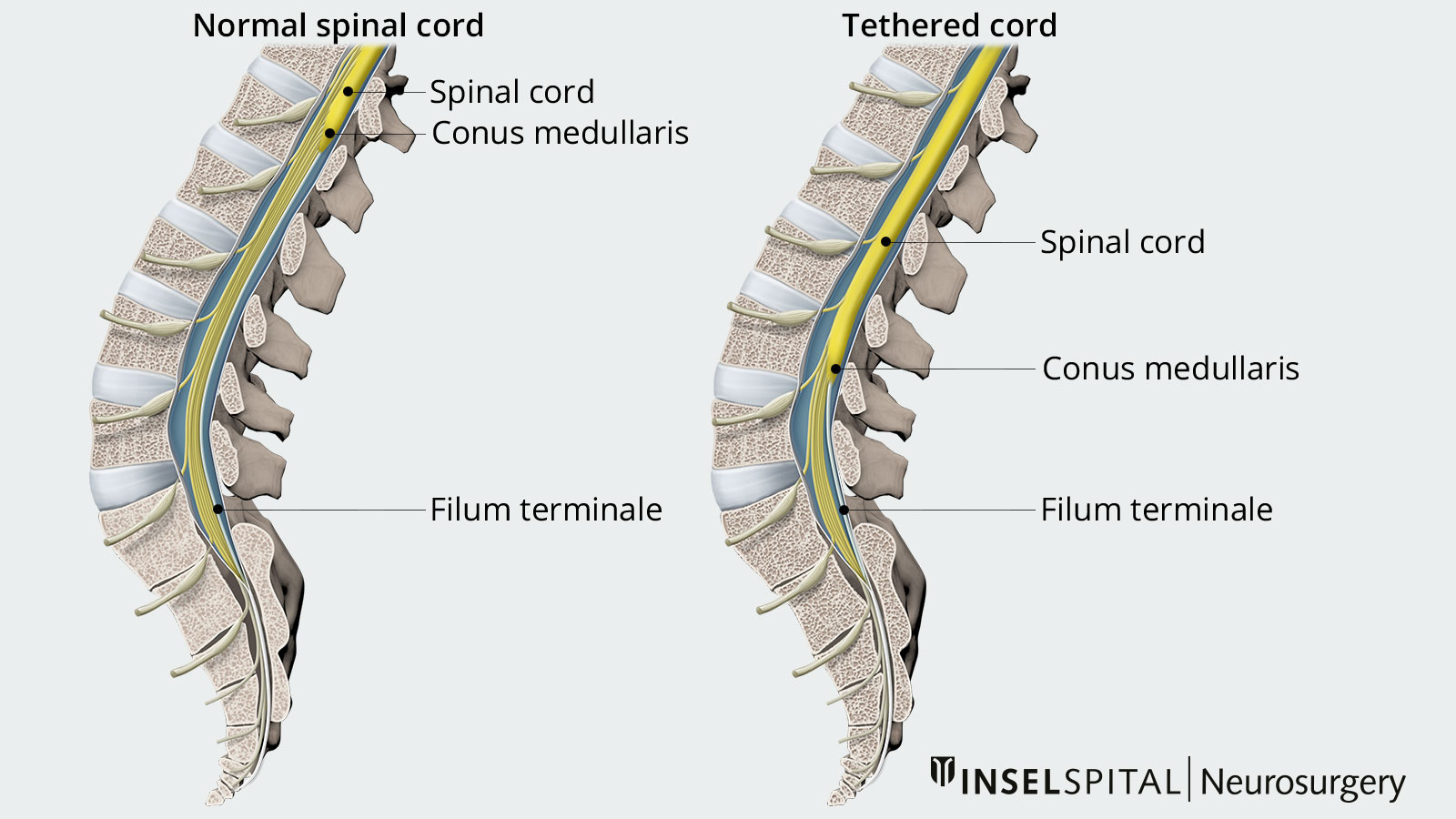 Comparative illustration of a TCS spinal cord with pathological adhesion and a normal spinal cord
