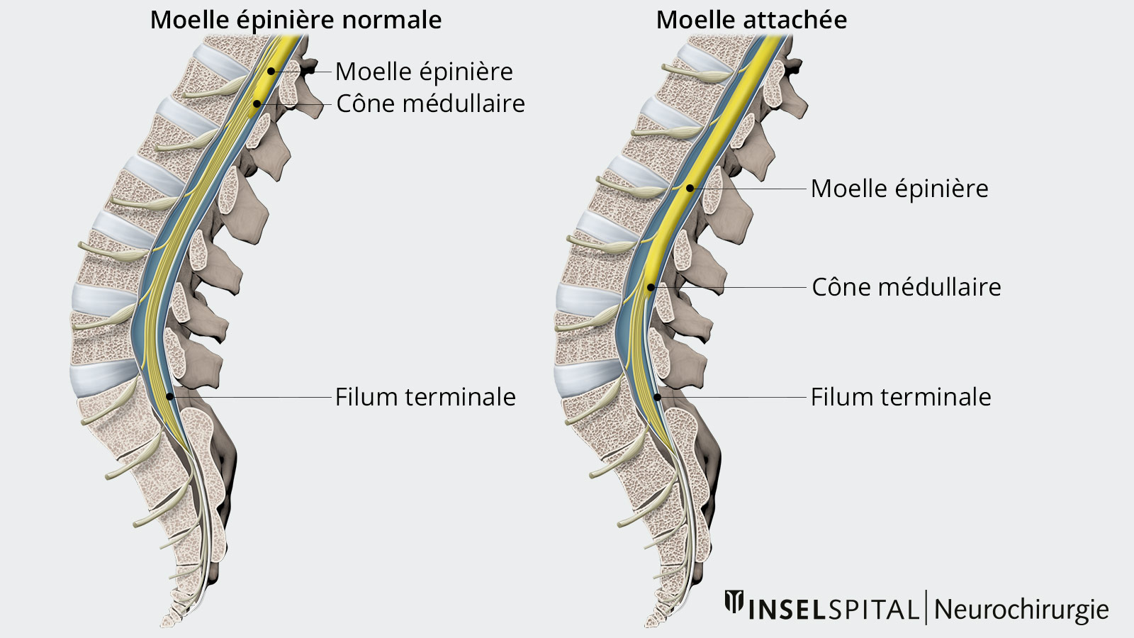 Schéma comparatif d'une moelle épinière présentant une adhérence pathologique et d'une moelle épinière normale