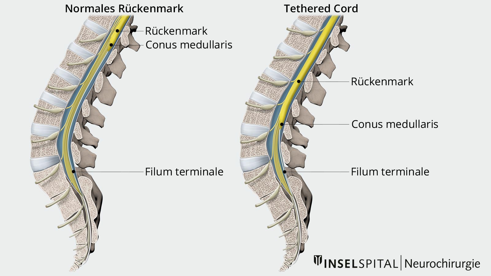 Vergleichszeichnung von TCS-Rückenmark mit pathologischer Anheftung und normalem Rückenmark