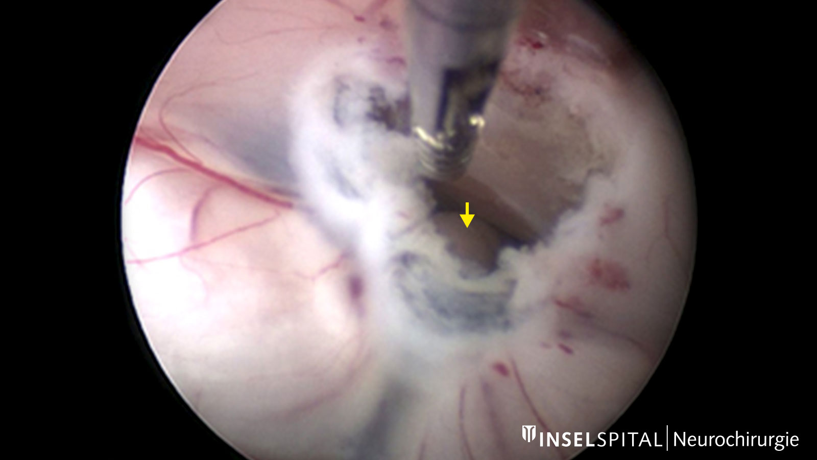 Kamerabild einer endoskopischen Drittventrikulozisternostomie mit Blick auf Arteria basilaris