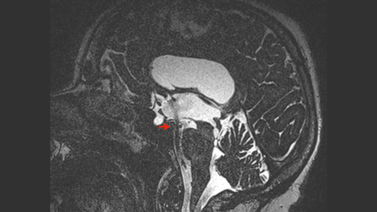 MRI-Bild nach OP mit deutlichem Flusssignal