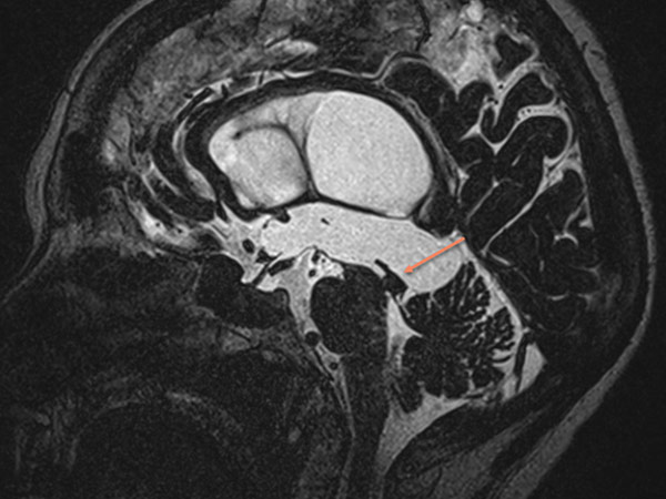 MRI-Bild in CISS-T2-Sequenz