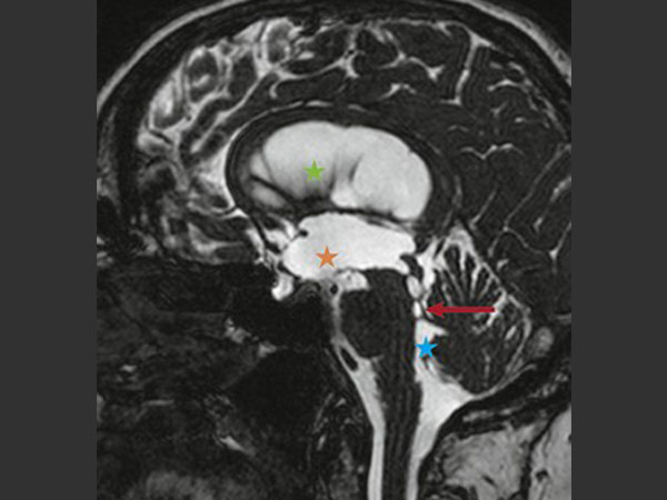 MRI image of aqueductal stenosis